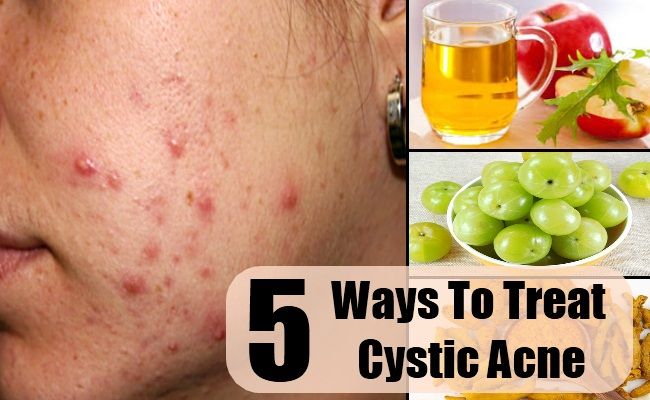 5 façons de traiter l'acné kystique