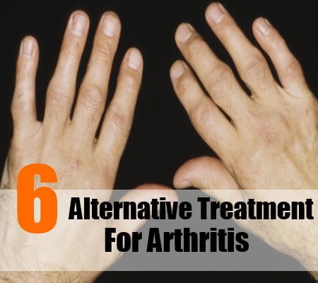 6 alternative de traitement pour l'arthrite