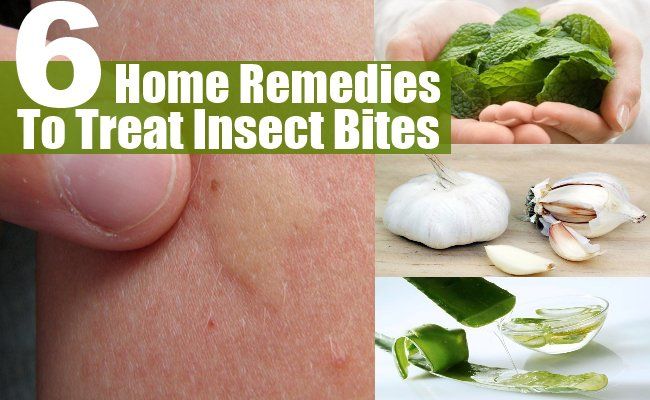 6 remèdes maison étonnants pour traiter les piqûres d'insectes