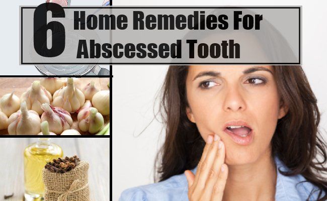 6 meilleurs remèdes maison pour l'abcès dentaire