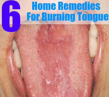 6 meilleurs remèdes maison pour langue brûlante