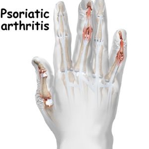 6 différentes options de traitement pour l'arthrite psoriasique