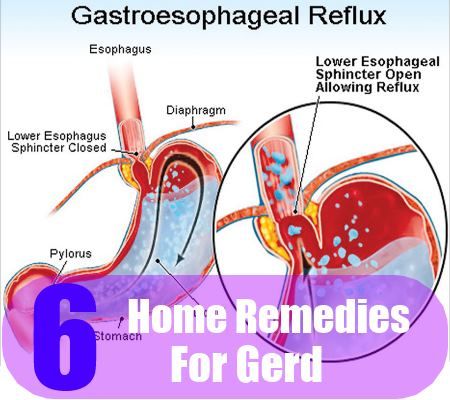 6 remèdes efficaces à domicile pour Gerd