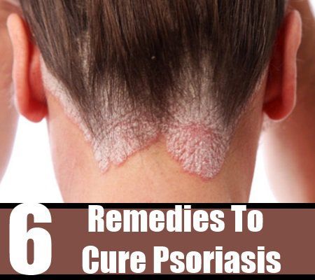 6 remèdes maison efficace pour guérir le psoriasis