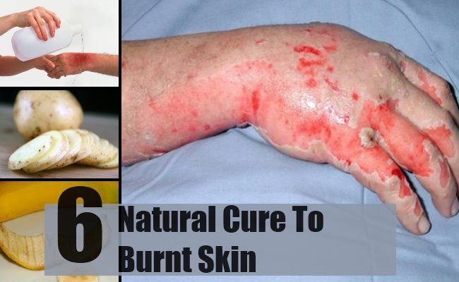 6 remèdes naturels efficaces pour la peau brûlée