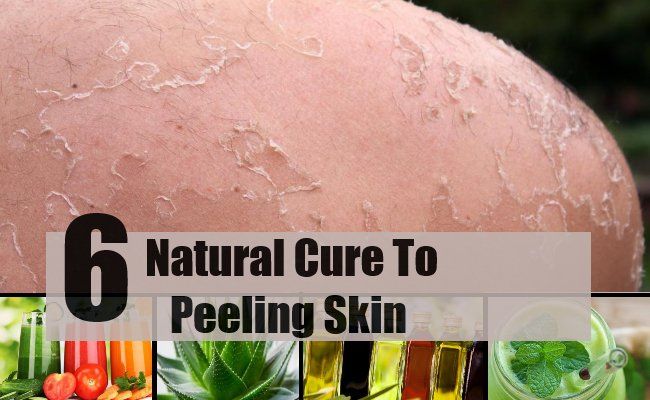 6 Remèdes naturels pour la peau qui pèle