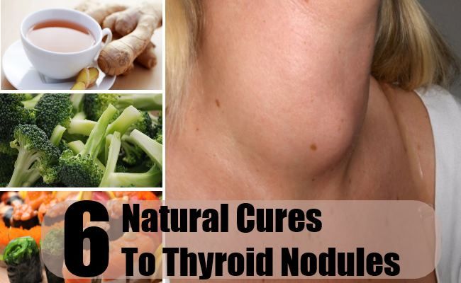 6 remèdes naturels à nodules thyroïdiens