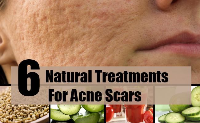 6 Scar, supprimer les traitements naturels pour les cicatrices d'acné