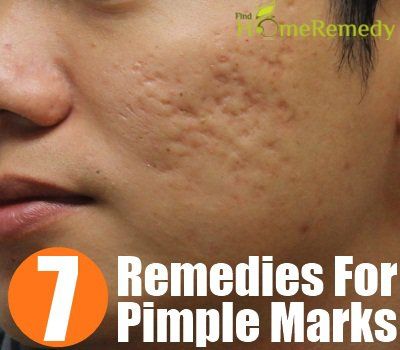 7 remèdes maison étonnants pour les marques Pimple