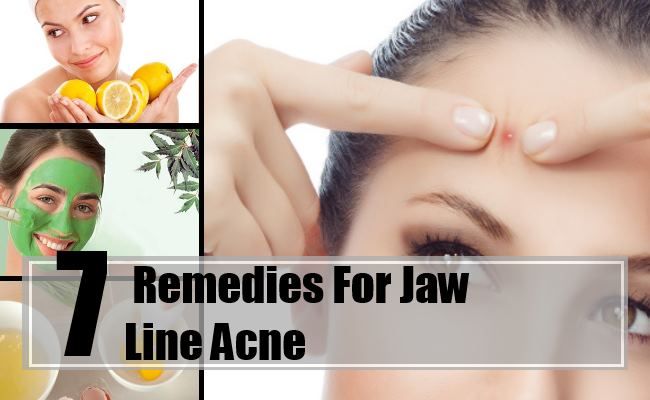 7 meilleurs remèdes maison pour l'acné de ligne de la mâchoire