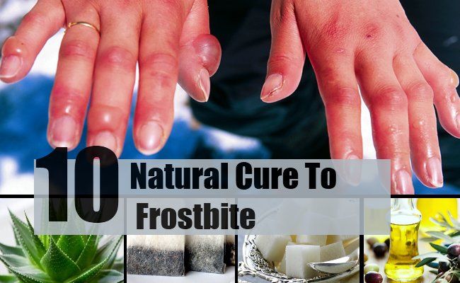 10 remèdes naturels gelures
