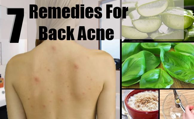 7 Les remèdes maison pour l'acné de retour