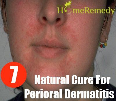 7 remède naturel pour la dermatite périorale