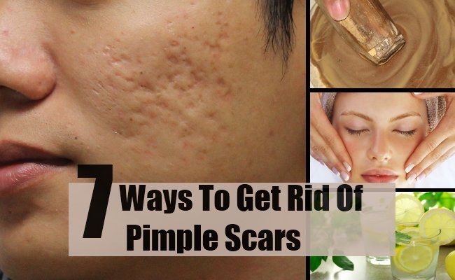 7 façons de se débarrasser des cicatrices Pimple