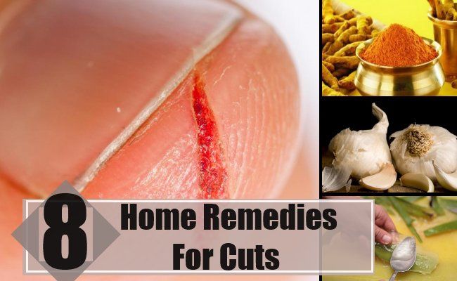 8 meilleurs remèdes maison pour les coupes