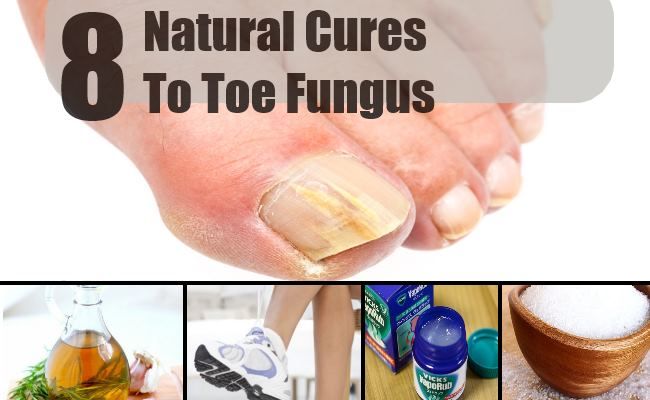 8 remèdes naturels pour mycose des pieds