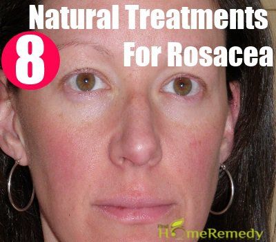 8 traitements naturels remarquables de la rosacée