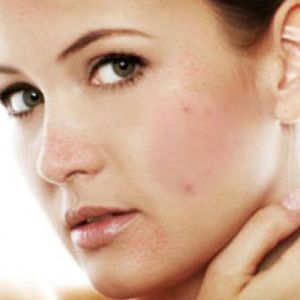 Masques faits maison pour prévenir l'acné