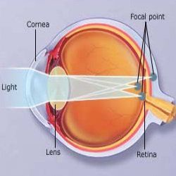 9 remèdes efficaces pour astigmatisme
