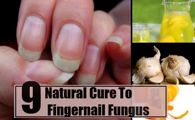 9 remède naturel pour la mycose des ongles
