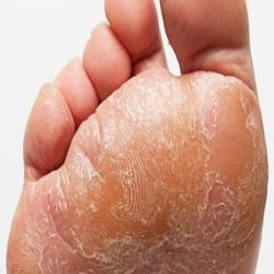 Les cinq conseils sur la façon de traiter la mycose des pieds