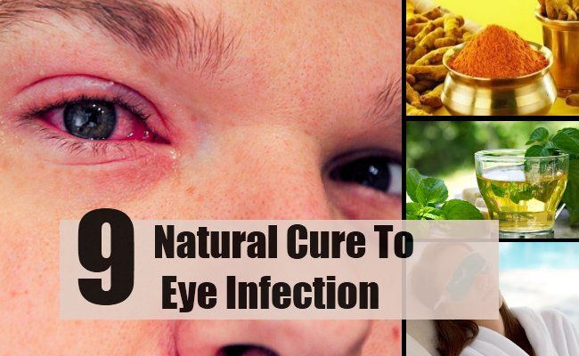 9 remèdes naturels pour infection de l'oeil