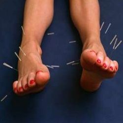 Points d'acupuncture pour la perte de poids