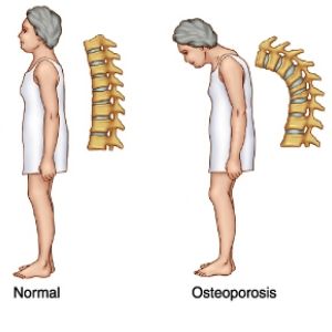 Remède naturel pour l'ostéoporose
