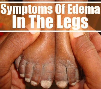 Les symptômes courants de l'œdème dans les jambes