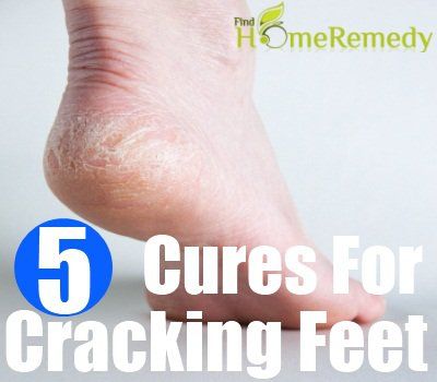 Remèdes naturels efficaces pour les pieds craquage