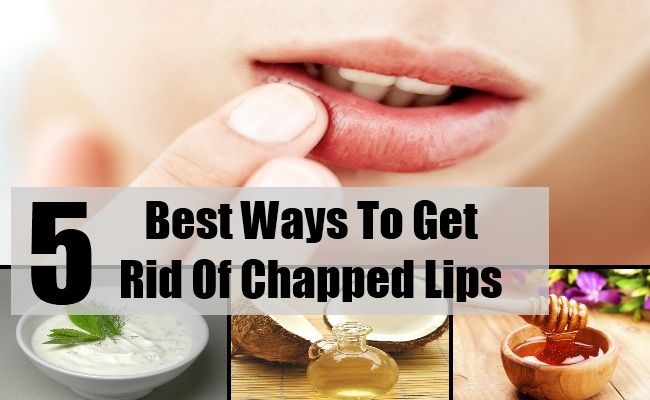 5 façons de se débarrasser des lèvres gercées