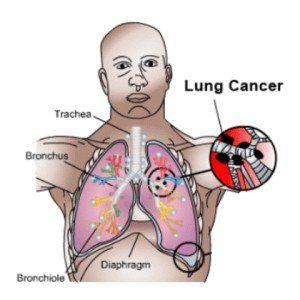 Cancer Du Poumon