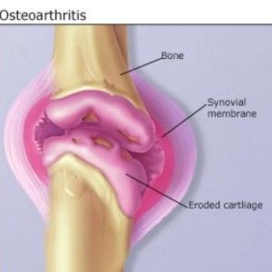 Comment traiter l'arthrose