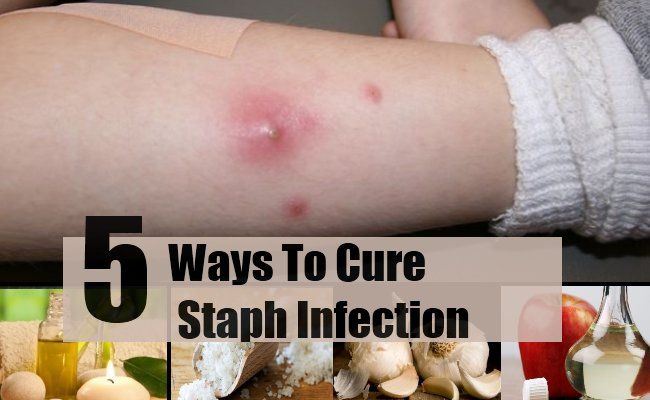 5 façons de guérir l'infection à staphylocoque