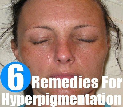 Comment se débarrasser de l'hyperpigmentation naturellement