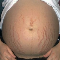 Comment prévenir les vergetures pendant la grossesse