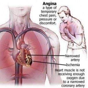 Comment traiter l'angine de poitrine en utilisant des vitamines