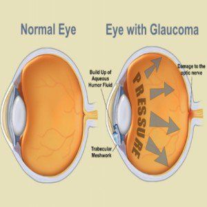 Top 6 des remèdes pour le glaucome