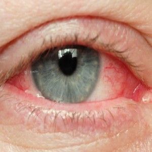 Comment traiter l'oeil rose