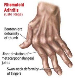 Comment traiter l'arthrite rhumatoïde