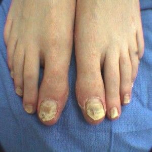 Comment traiter la mycose des pieds