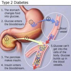 Le diabète de type 2
