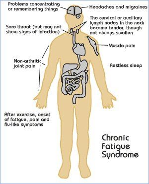 Cure syndrome de fatigue chronique
