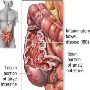 Natural Cure Pour Crohn's Disease 