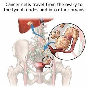 Remède naturel pour le cancer ovarien