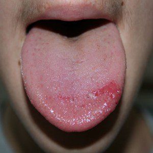 Tongue Brûler