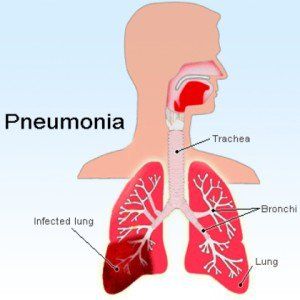 Remèdes puissants pour la pneumonie