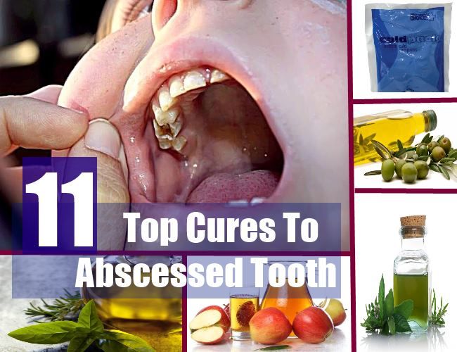 Top 11 des remèdes naturels à abcès dentaire