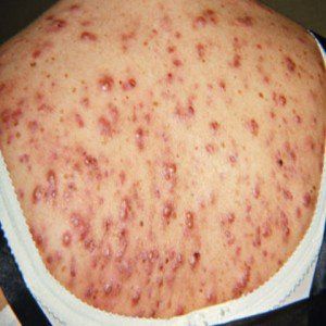 L'acné kystique