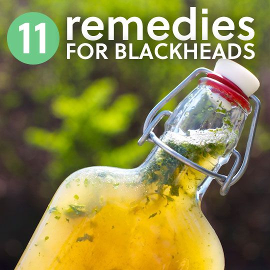 11 remèdes simples pour se débarrasser de Blackheads- ceux-ci fonctionnent très bien pour moi! Bien mieux que d'utiliser des bandes de pores achetés en magasin et exfoliants chimiques.